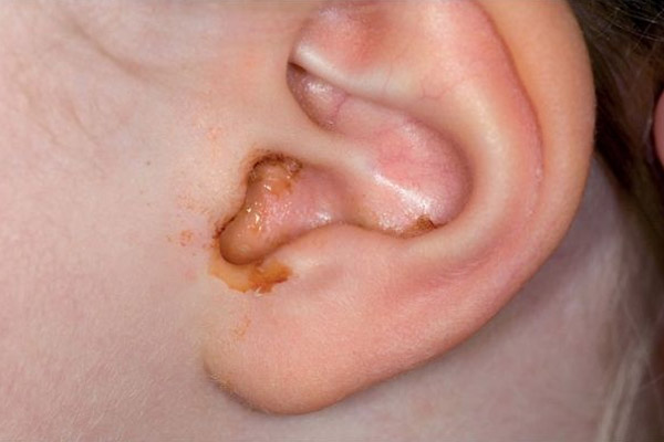 Viêm tai giữa do vi khuẩn hoặc virus gây ra tình trạng đau nhức trong tai, chảy dịch